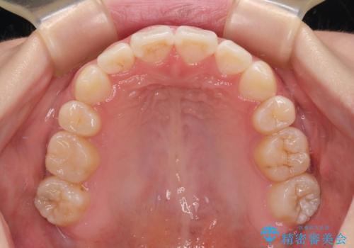 上下非接触の前歯 口元の突出感を改善する抜歯矯正の治療後