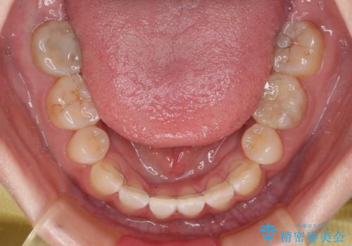 上下非接触の前歯 口元の突出感を改善する抜歯矯正の治療後