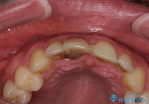 首の皮一枚で繋がっている前歯 1DAYインプラントでスムーズに治療の治療前