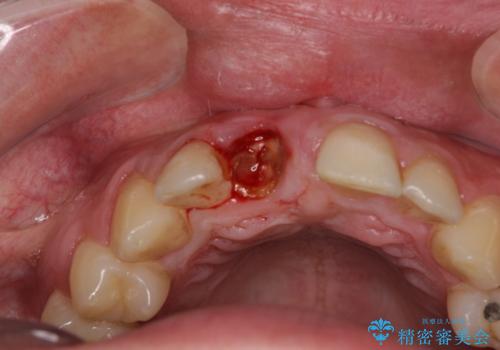 首の皮一枚で繋がっている前歯 1DAYインプラントでスムーズに治療の治療前