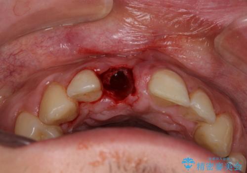 首の皮一枚で繋がっている前歯 1DAYインプラントでスムーズに治療の治療中