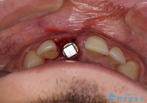 首の皮一枚で繋がっている前歯 1DAYインプラントでスムーズに治療の治療後