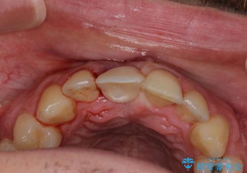 首の皮一枚で繋がっている前歯 1DAYインプラントでスムーズに治療の治療中