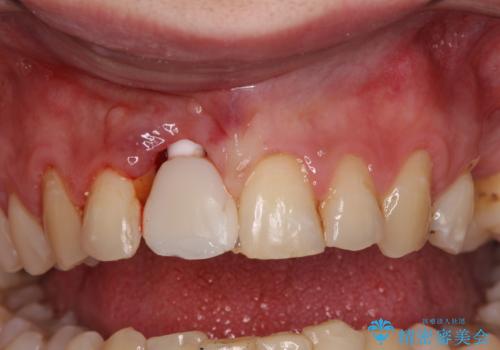 首の皮一枚で繋がっている前歯 1DAYインプラントでスムーズに治療の治療中