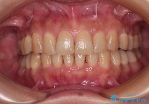 ディープバイトと前歯のデコボコ インビザラインによる矯正治療の治療中