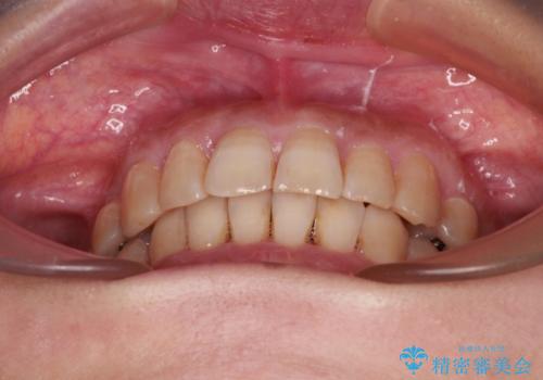 ディープバイトと前歯のデコボコ インビザラインによる矯正治療の治療中