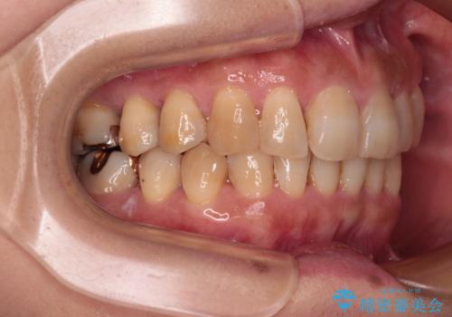 ディープバイトと前歯のデコボコ インビザラインによる矯正治療の治療中