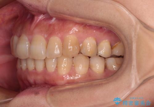 ディープバイトと前歯のデコボコ インビザラインによる矯正治療の治療中