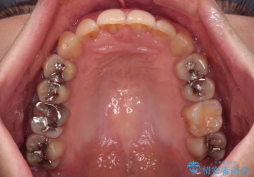ディープバイトと前歯のデコボコ インビザラインによる矯正治療の治療中