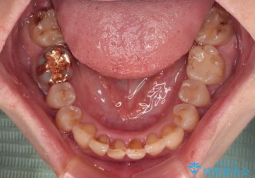 ディープバイトと前歯のデコボコ インビザラインによる矯正治療の治療中