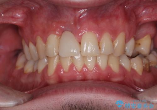 首の皮一枚で繋がっている前歯 1DAYインプラントでスムーズに治療の治療後