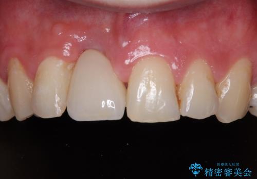 首の皮一枚で繋がっている前歯 1DAYインプラントでスムーズに治療の症例 治療後