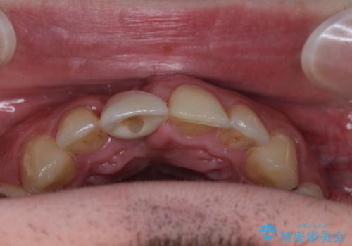 首の皮一枚で繋がっている前歯 1DAYインプラントでスムーズに治療の治療後