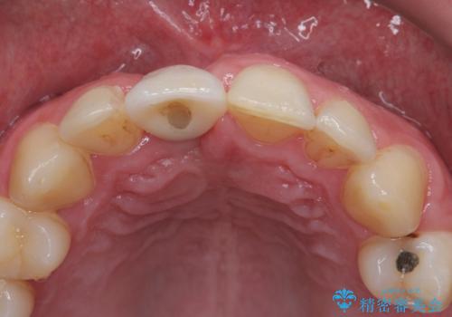 首の皮一枚で繋がっている前歯 1DAYインプラントでスムーズに治療の治療後