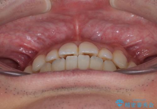 内側に引っ込んだ歯を治したい インビザラインの矯正治療の治療後