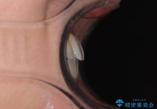 内側に引っ込んだ歯を治したい インビザラインの矯正治療の治療後