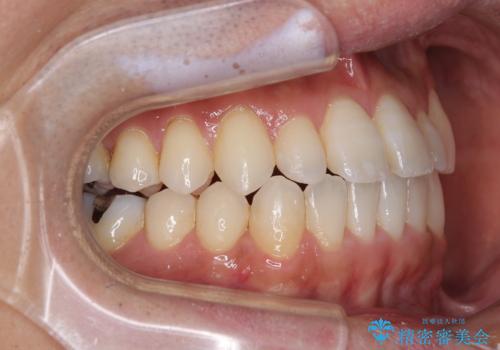 内側に引っ込んだ歯を治したい インビザラインの矯正治療の治療後