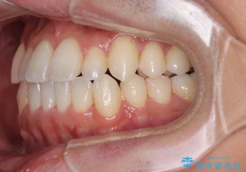 内側に引っ込んだ歯を治したい インビザラインの矯正治療の治療後