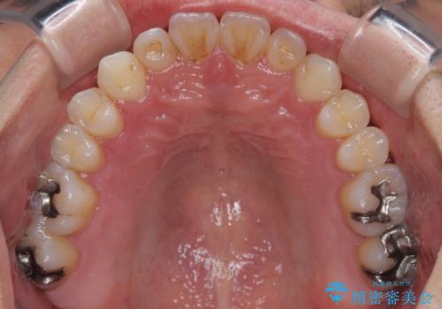 内側に引っ込んだ歯を治したい インビザラインの矯正治療の治療後