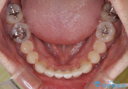 内側に引っ込んだ歯を治したい インビザラインの矯正治療の治療後