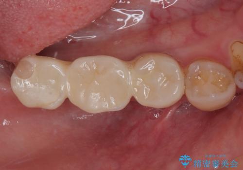 奥歯がぐらぐらする インプラントによる補綴治療の症例 治療後