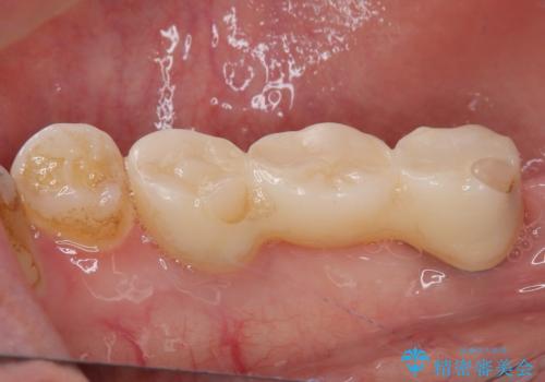 奥歯がぐらぐらする インプラントによる補綴治療の治療後