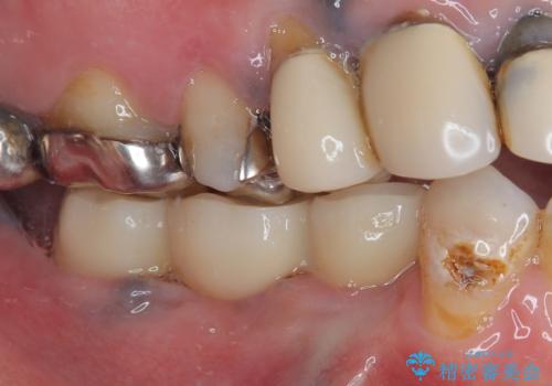 奥歯がぐらぐらする インプラントによる補綴治療の治療後