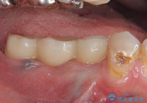 奥歯がぐらぐらする インプラントによる補綴治療の治療後