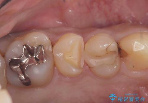 虫歯治療|歯を長持ちさせるための治療|セラッミクインレー|審美回復の治療中