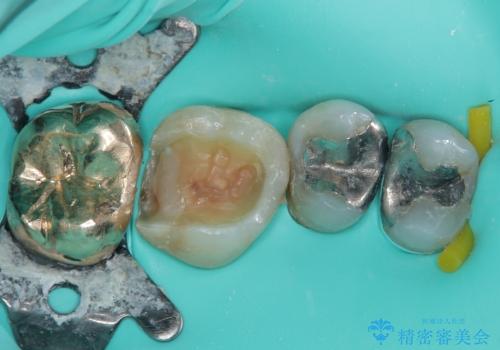 詰め物が欠けた ハイブリッドインレー修復の治療中