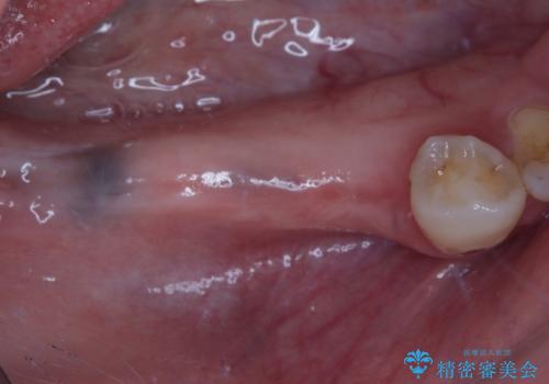奥歯がぐらぐらする インプラントによる補綴治療の治療中