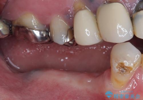奥歯がぐらぐらする インプラントによる補綴治療の治療中