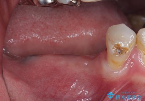奥歯がぐらぐらする インプラントによる補綴治療の治療中