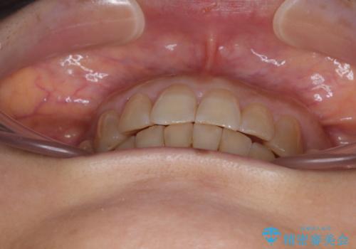 ディープバイトと前歯のデコボコ インビザラインによる矯正治療の治療後