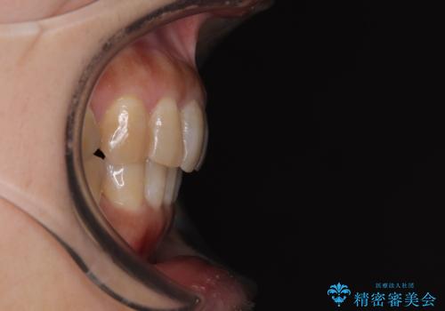 ディープバイトと前歯のデコボコ インビザラインによる矯正治療の治療後