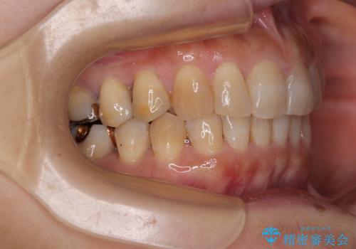 ディープバイトと前歯のデコボコ インビザラインによる矯正治療の治療後