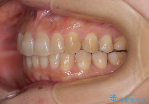 ディープバイトと前歯のデコボコ インビザラインによる矯正治療の治療後