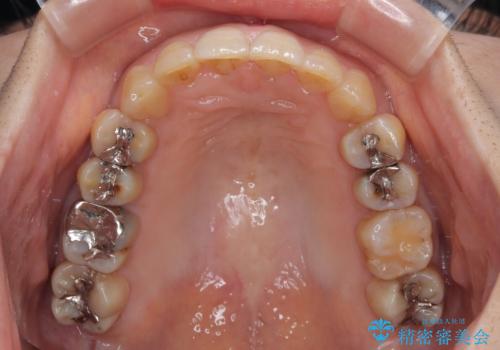 ディープバイトと前歯のデコボコ インビザラインによる矯正治療の治療後