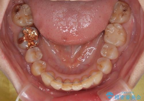 ディープバイトと前歯のデコボコ インビザラインによる矯正治療の治療後