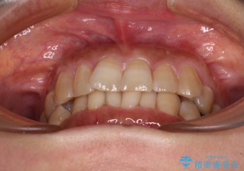 ディープバイトと前歯のデコボコ インビザラインによる矯正治療の治療前