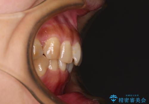 ディープバイトと前歯のデコボコ インビザラインによる矯正治療の治療前