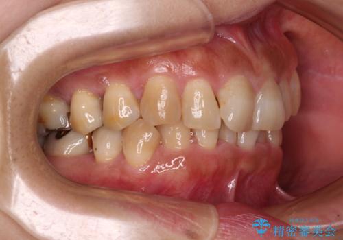 ディープバイトと前歯のデコボコ インビザラインによる矯正治療の治療前