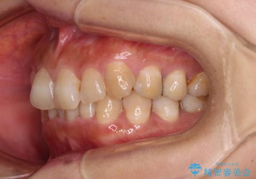 ディープバイトと前歯のデコボコ インビザラインによる矯正治療の治療前