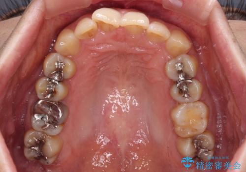 ディープバイトと前歯のデコボコ インビザラインによる矯正治療の治療前