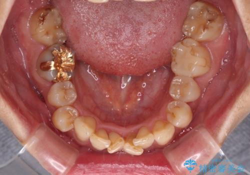 ディープバイトと前歯のデコボコ インビザラインによる矯正治療の治療前