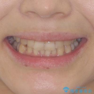 ディープバイトと前歯のデコボコ インビザラインによる矯正治療の治療前(顔貌)