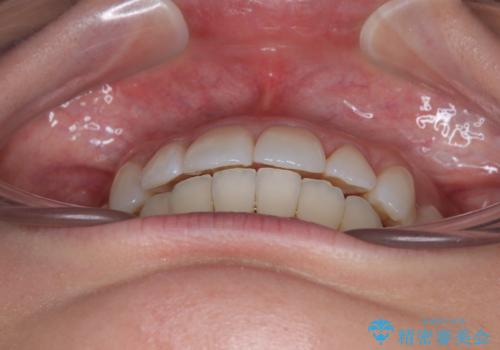 上下前歯のデコボコ ワイヤー装置で楽ちん矯正治療の治療後