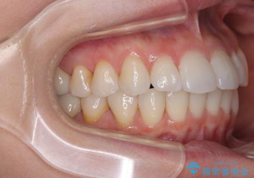 上下前歯のデコボコ ワイヤー装置で楽ちん矯正治療の治療後