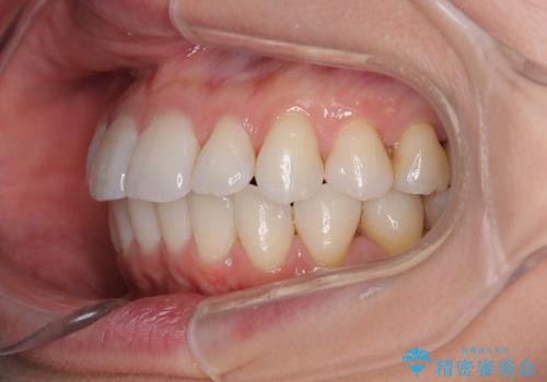 上下前歯のデコボコ ワイヤー装置で楽ちん矯正治療の治療後