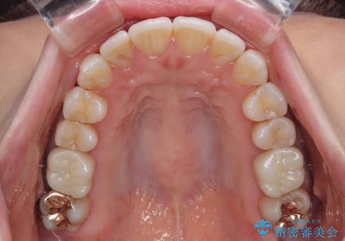 上下前歯のデコボコ ワイヤー装置で楽ちん矯正治療の治療後